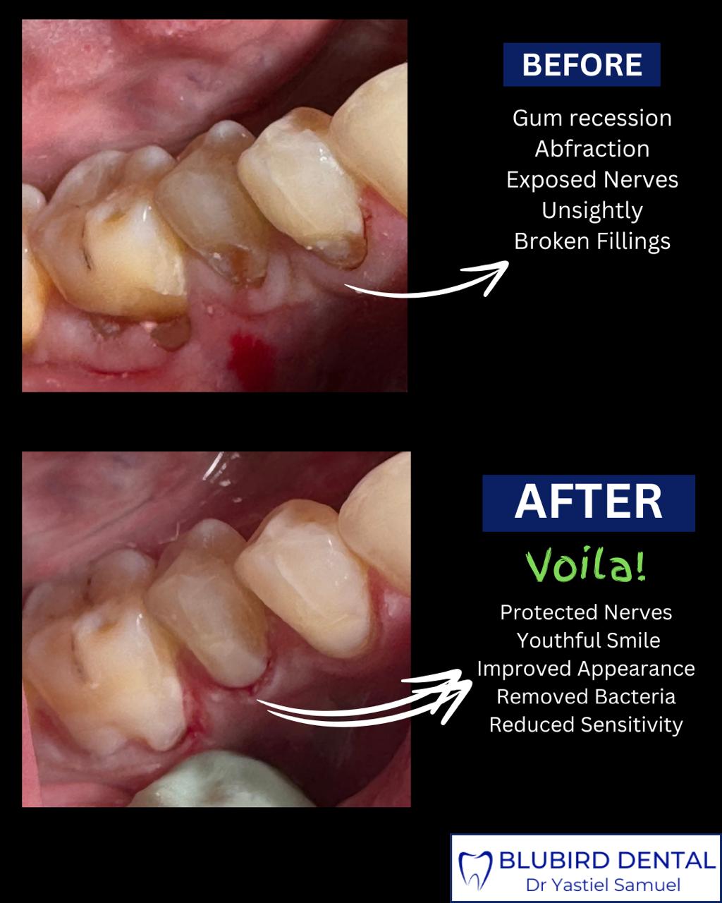 Before and after composite filling repairing gum recession and broken fillings