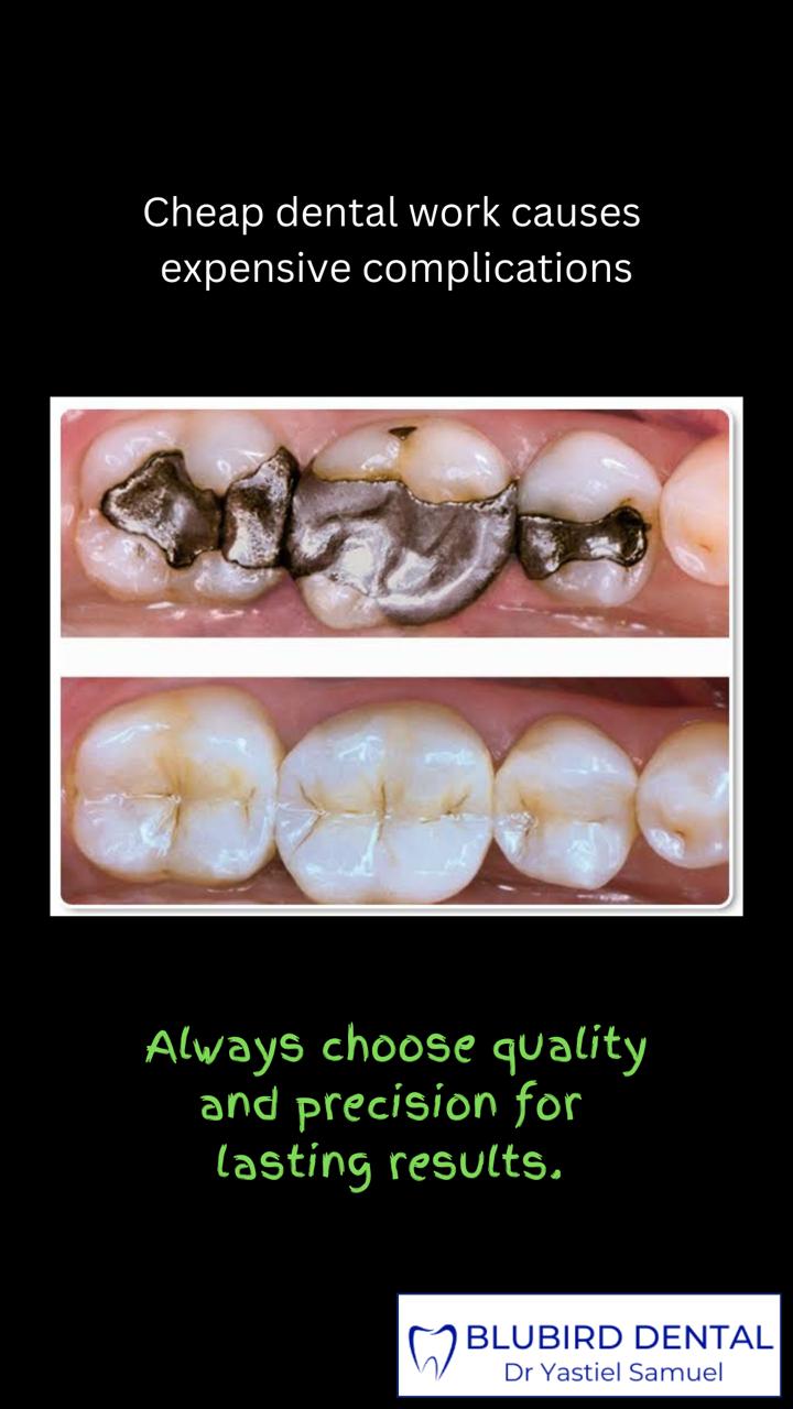 Old amalgam fillings replaced with natural-looking composite fillings