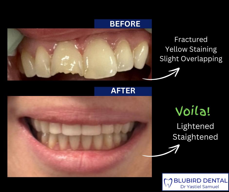 Before and after result of restoring a fractured, stained front tooth