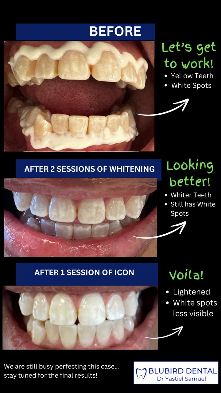 Teeth whitening progression from yellow staining to a brighter smile